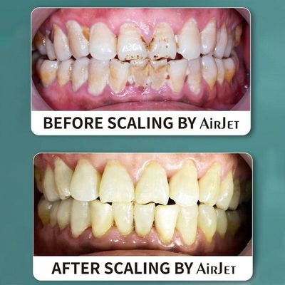 Multicolor Practical Dental Air Prophy Jet พร้อมที่จับตามหลักสรีรศาสตร์